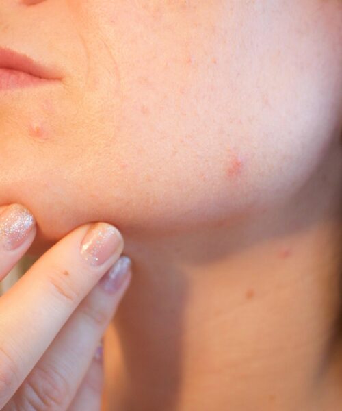 Nem tudod abbahagyni a pattanások nyomkodását? Íme néhány módszer, ami segíthet!